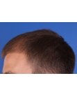 Before Hair Transplant&nbsp;Front
